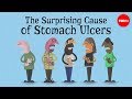 The Surprising Cause Of Stomach Ulcers Rusha Modi 