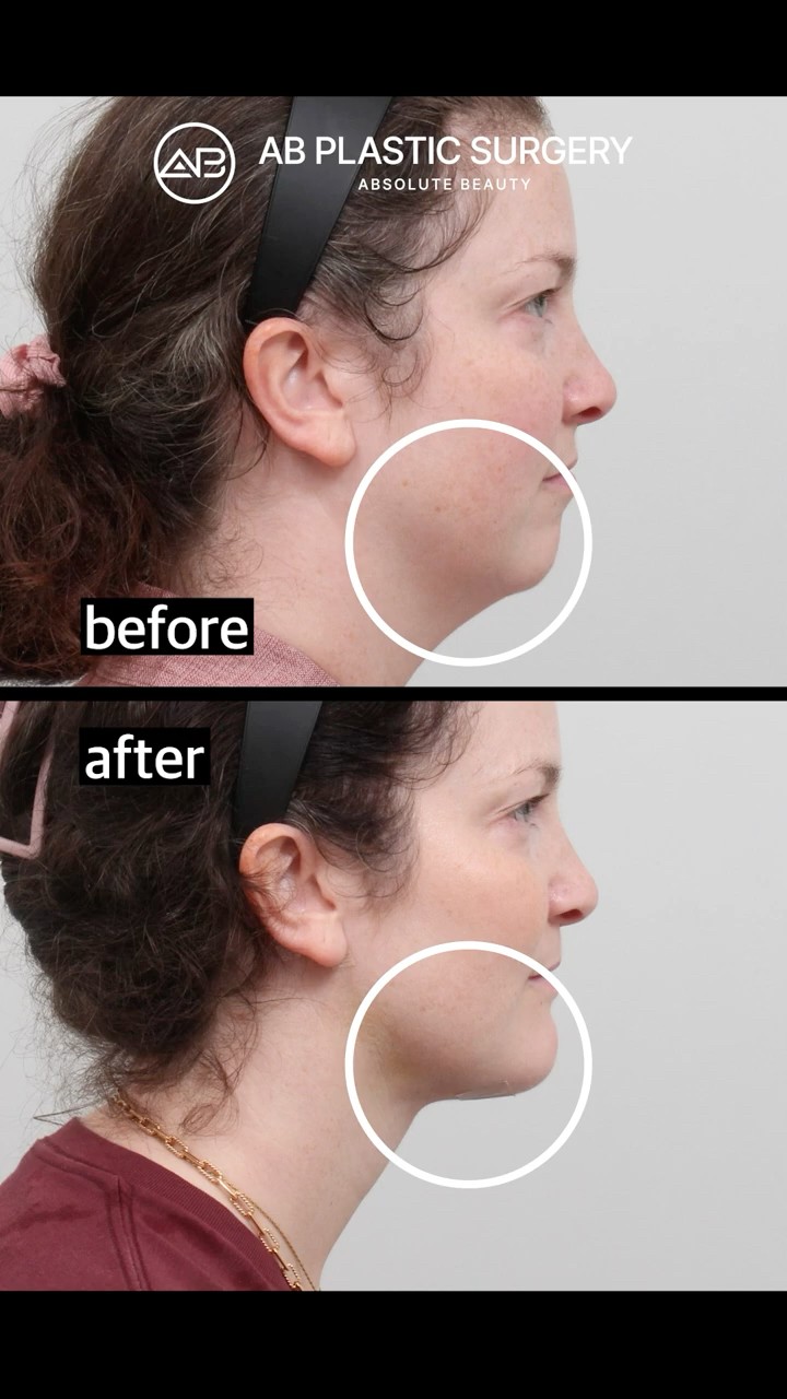 Chin Advancement and Double Chin Liposuction Transformation #Shorts