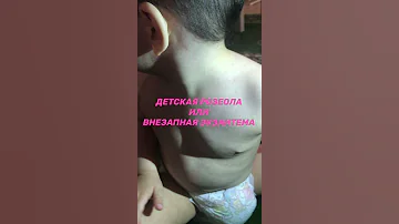Детская розеола (внезапная экзантема/вирус герпеса 6 или 7 типа) | Сыпь