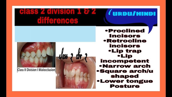 malocclusions..Class I,Class II,Class III..Clinical features