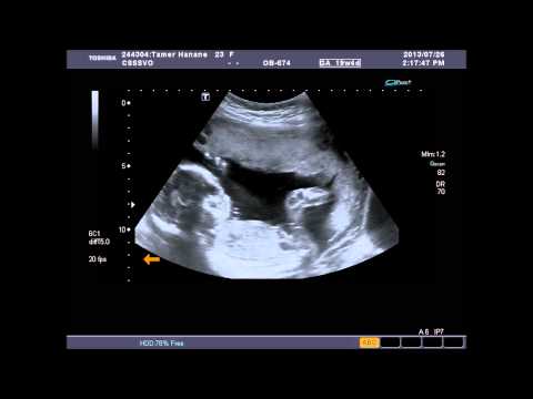 Échographie-19-semaines-de-mon-bebe-samy--19-weeks-ultrasound