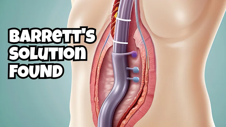 The Barrett's Esophagus Solution