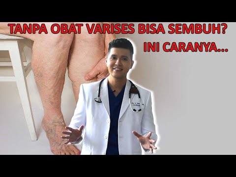 Video: 3 Cara Meredakan Sakit Varises Vena