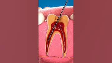 Broken File in Root Canal: Is It Safe to Leave It Inside?