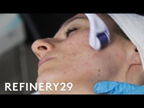 Why Microneedling Is The Best Acne Scar Treatment | Macro Beauty | Refinery