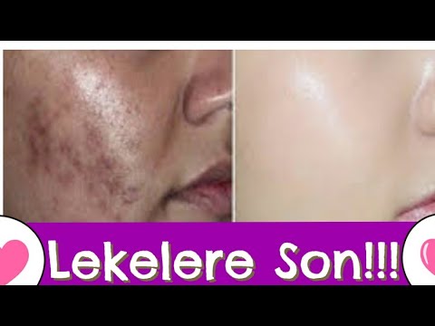 Lekelere ve Çillere qarşı ağardıcı tebii maska.Lekeleri bir kaç ton açan maske tarifi