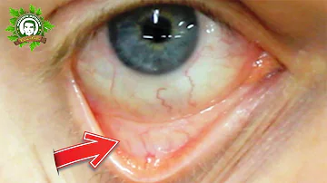 ¿Se puede saber si alguien tiene anemia mirándole a los ojos?