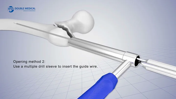 Proximal Femoral Nailing Surgical Technique | Step-by-Step Animation with Proximal Femoral Long Nail