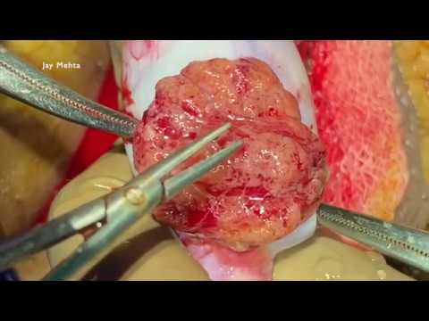 Azoospermia Treatment microTESE for Non Obstructive Azoospermia (NOA)