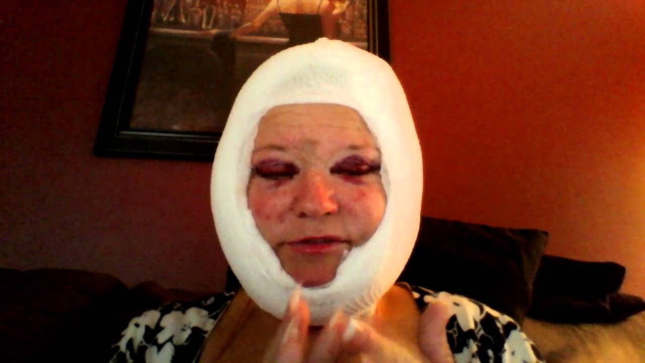 Full Face and Neck Lift with Upper and Lower Blepharoplasty Surgery Day 2 - YouTube