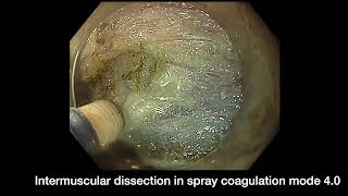 Salvage Endoscopic Intermuscular Dissection for Residual Rectal NET