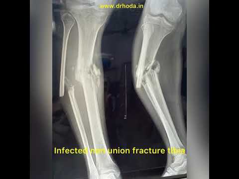 Ilizarov in infected tibia non union with deformity - Dr Hoda Ilizarov cases