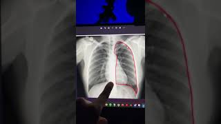 5 pasos para interpretar un radiografía de tórax