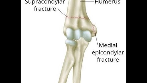 Fracture Closed treatment Humeral CPT code - simplify medical coding