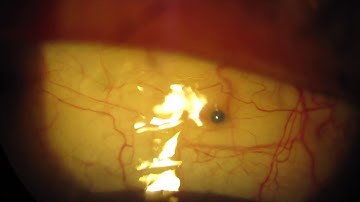 Combined YAMANE-DMEK