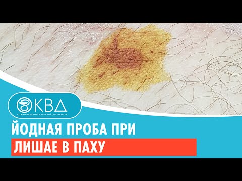 ✅ Йодная проба при лишае в паху. Клинический случай №268