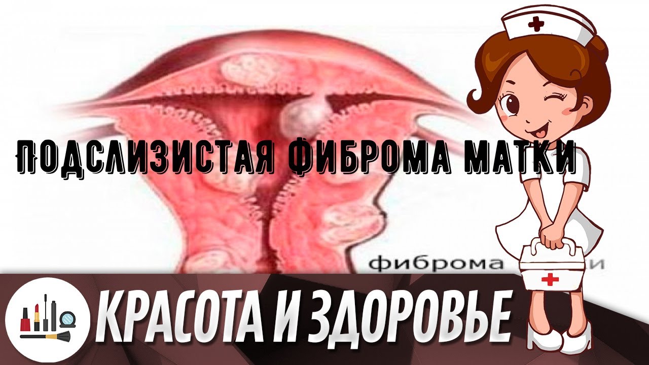 Подслизистая фиброма матки - YouTube