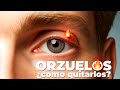 🔥 ORZUELOS: ¿Qué son y que hacer? 👁