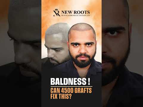4500 Grafts Hair Transplant in Kolhapur | Cost and Best Results | Marathi #hair #shorts