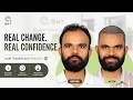 Hair Transplant in Lucknow (HX-RFSK) | Best Results & Cost of Hair Transplant in Lucknow