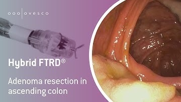 FTRD® System | Hybrid FTRD | Adenoma resection in ascending colon