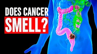Early Signs of Colon Cancer Symptoms Don't Ignore These Simple Signs