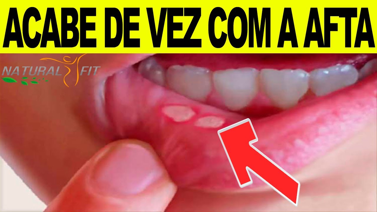 Como CURAR AFTAS Na Boca MUITO RÁPIDO | MÉTODO CASEIRO | 5 DICAS FÁCEIS ...