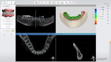3Shape Implant Studio - Alinhamento de escaneamentos e Definição do nervo