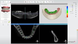 3Shape Implant Studio - Alinhamento de escaneamentos e Definição do nervo