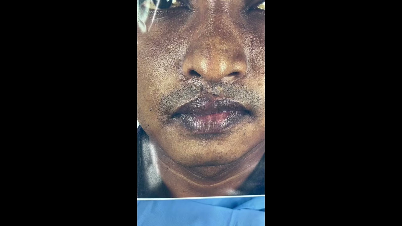 Before and After Road accident lip scar treatment by dr sunil richardson