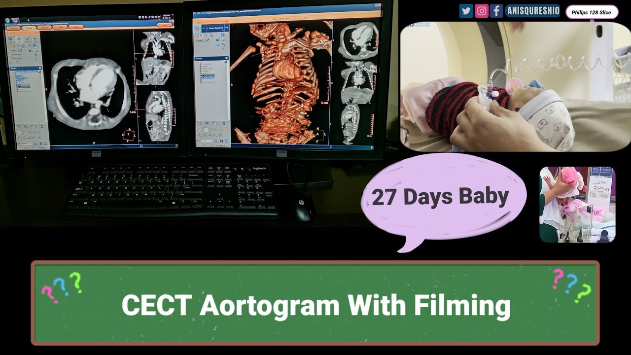 CECT Aortogram With Fliming | 27 Days Baby 🍼 | By Anis Qureshi