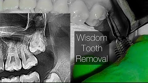 Maxillary Wisdom Teeth Extractions Step by Step