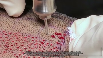 Supplementary Video 3: Intuitive Depth Control Demo in an All-Purpose FUE System