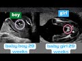 Ultrasound showing a boy and a girl baby both at 29 weeks