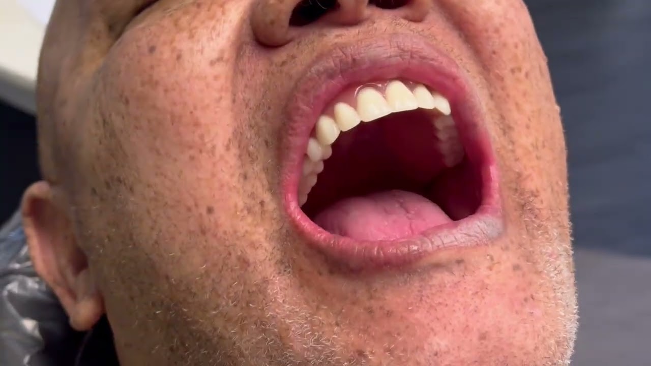 Implant Supported Removable Denture