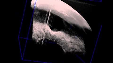 Reconstituted 3-Dimensional Anterior-Segment Optical Coherence Tomographic Images of a Filtering Ble