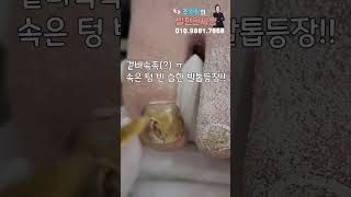 고민하다 드디어 관리 받다 #shorts #내성발톱 #무좀발톱 #무좀관리 #ingrown #toenails