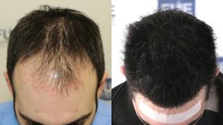 FUE Hair Transplant (3467 + 1000 grafts in NW  Class IV  A), Dr. Juan Couto  FUEXPERT CLINIC