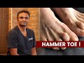 Hammer toe   dr sree charan