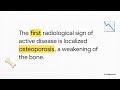 Spinal TB  Pott s Disease