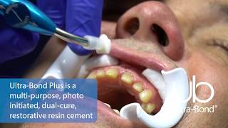 Ultra-Bond® - 30-Second Dentistry™ - Patient: Randy Ultra-Bond® - 30-Second Dentistry™ - Patient: Randy