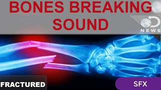 Bones Breaking Sound Effect Bone Fractured Hand Broken