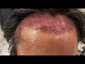 Dallas Hair Transplant Postop Closeup for Turban Traction Hair Loss