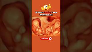 12 Weeks Dancing Twins 😍 4D Ultrasound #baby #ultrasound #funnybaby