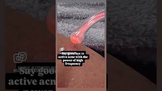 #pimple #acne #highfrequencyhealing #pimpletreatment #acnescartreatment #viral #explore #beauty #fy