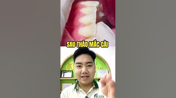 Vệ Sinh Sau Khi Tháo Mắc Cài - Niềng Răng Đau Nhất Khi Nào? #nhakhoa #rang