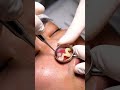 This Acne Was READY to Pop 🤯 #asmr #skincare #macroskin #satisfying #blackheadremoval #relaxing