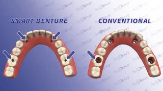 Smart Denture Conversions Protocol by Avadent