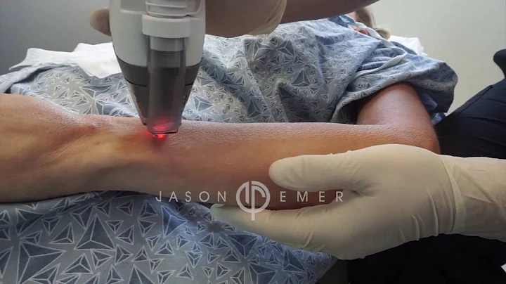 Fraxel Laser / Arm Skin Resurfacing / Collagen Remodeling / Beverly Hills California