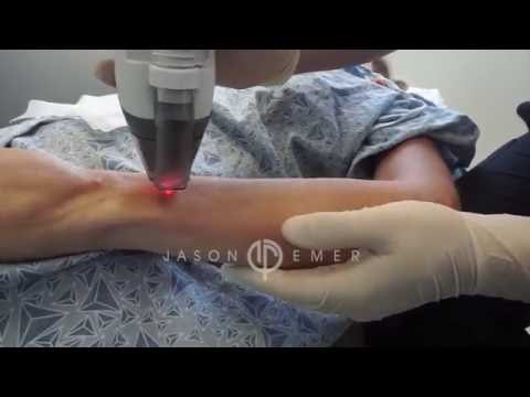 Fraxel Laser /